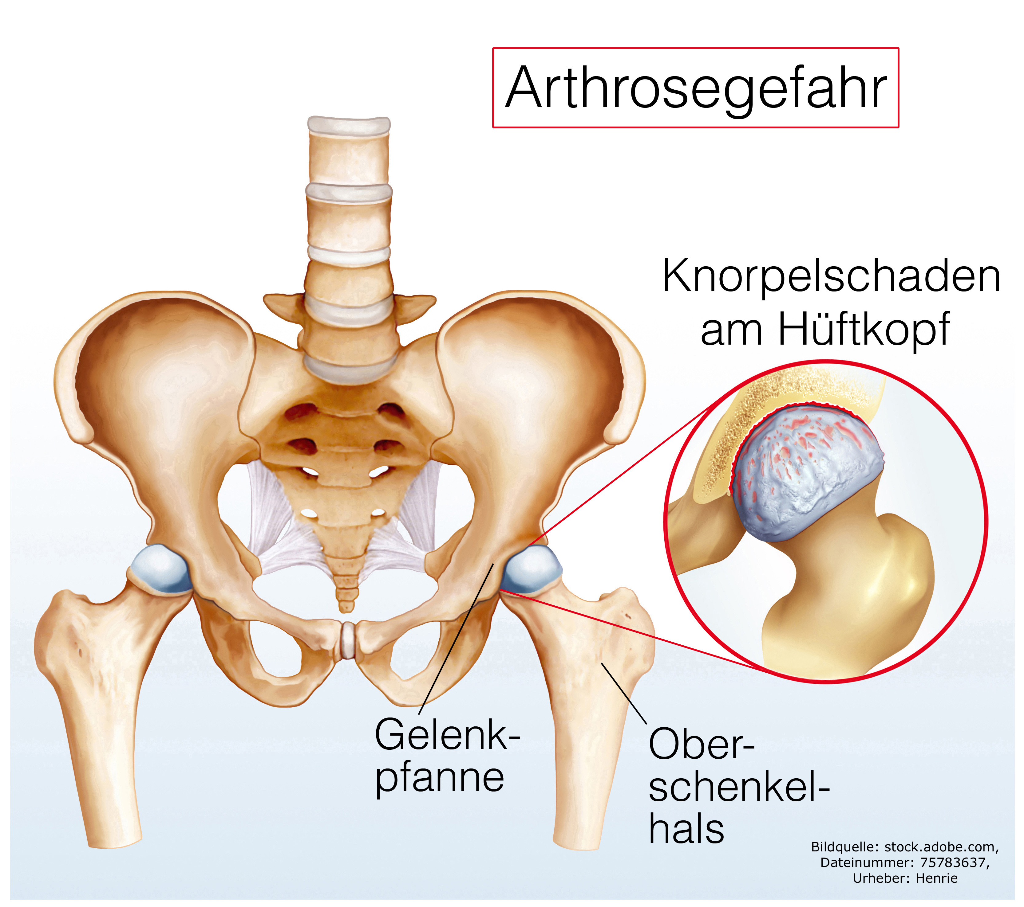 Arthrose Hüftgelenk - Gesundheitscoach David Stein, Bendorf bei Koblenz, Mayen, Andernach, Neuwied, Lahnstein